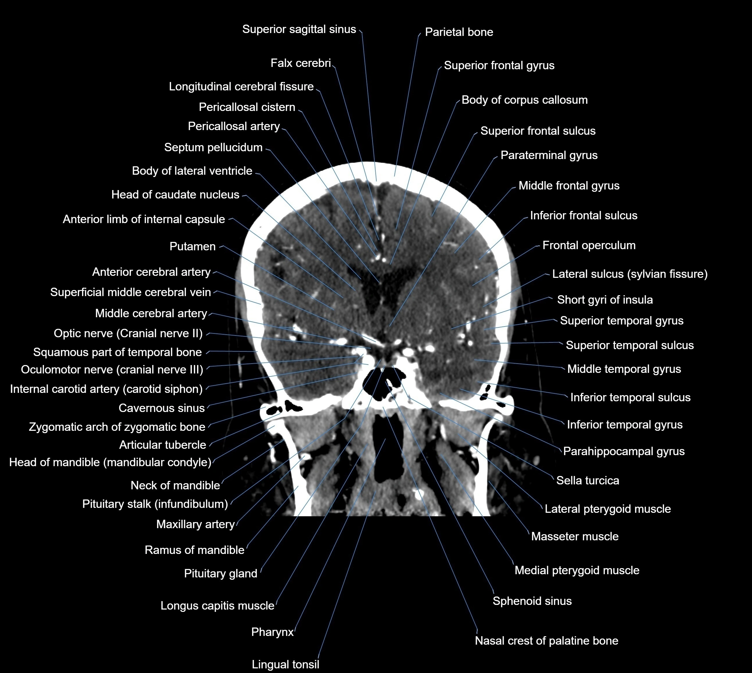 CT Brain coronal cross sectional radiology anatomy image  -img-00001-020.webp